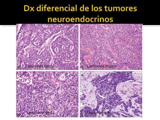 Carcinoide típico Carcinoide atipico Carcinoma de C L Celulas pequeñas 