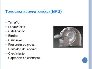 TOMOGRAFÍACOMPUTARIZADA(NPS)

•   Tamaño
•   Localización
•   Calcificación
•   Bordes
•   Cavitación
•   Presencia de grasa
•   Densidad del nodulo
•   Crecimiento
•   Captación de contraste
 