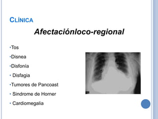 CLÍNICA
             Afectaciónloco-regional
•Tos
•Disnea
•Disfonía
• Disfagia
•Tumores de Pancoast
• Sindrome de Horner
• Cardiomegalia
 