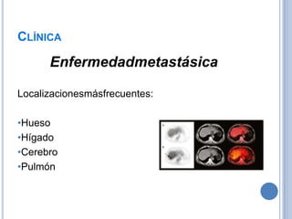 CLÍNICA
      Enfermedadmetastásica

Localizacionesmásfrecuentes:

•Hueso
•Hígado
•Cerebro
•Pulmón
 