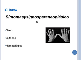 CLÍNICA
Síntomasysignosparaneoplásico
              s

•Oseo

•Cutáneo

•Hematológico
 