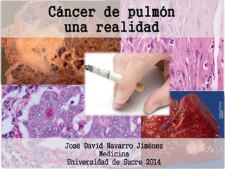 Cáncer de pulmón 
una realidad 
José David Navarro Jiménez 
Medicina 
Universidad de Sucre 2014 
 