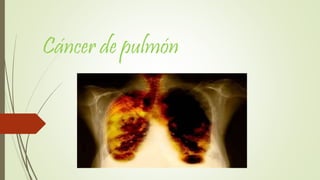Cáncer de pulmón
 