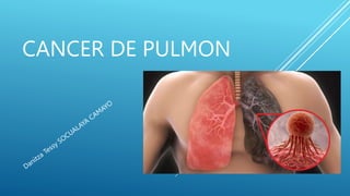 CANCER DE PULMON
 