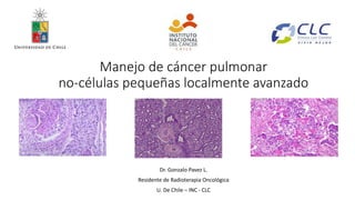 Manejo de cáncer pulmonar
no-células pequeñas localmente avanzado
Dr. Gonzalo Pavez L.
Residente de Radioterapia Oncológica
U. De Chile – INC - CLC
 