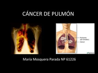 CÁNCER DE PULMÓN
María Mosquera Parada NP 61226
 