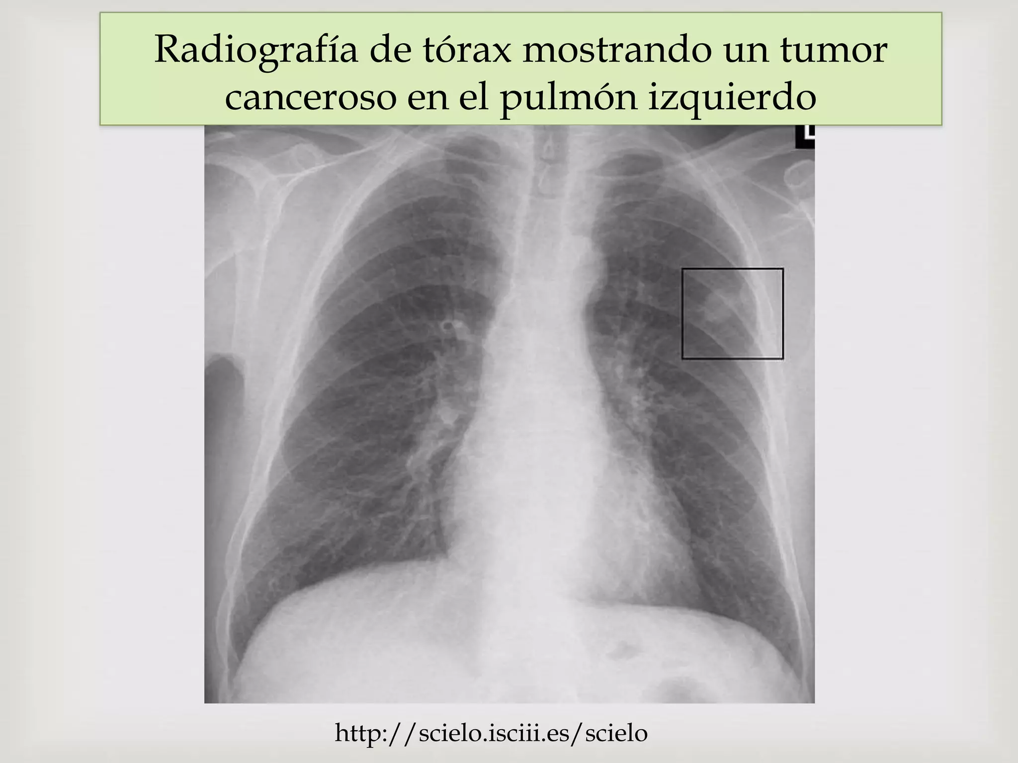 Imagenologia De C ncer De Pulm n Primario Y Metast sico PPTX imagenologia-de-c-ncer-de-pulm-n-primario-y-metast-sico-pptx