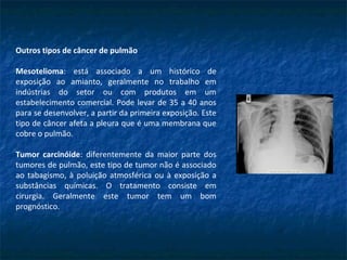 Outros tipos de câncer de pulmão
Mesotelioma: está associado a um histórico de
exposição ao amianto, geralmente no trabalho em
indústrias do setor ou com produtos em um
estabelecimento comercial. Pode levar de 35 a 40 anos
para se desenvolver, a partir da primeira exposição. Este
tipo de câncer afeta a pleura que é uma membrana que
cobre o pulmão.
Tumor carcinóide: diferentemente da maior parte dos
tumores de pulmão, este tipo de tumor não é associado
ao tabagismo, à poluição atmosférica ou à exposição a
substâncias químicas. O tratamento consiste em
cirurgia. Geralmente este tumor tem um bom
prognóstico.
 