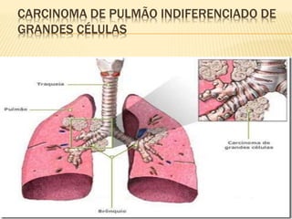 CARCINOMA DE PULMÃO INDIFERENCIADO DE
GRANDES CÉLULAS
 