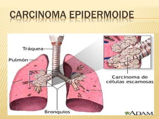 CARCINOMA EPIDERMOIDE
 