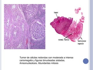 Tumor de células redondas con moderada a intensa
cariomegalia y figuras binucleadas aisladas.
Anisonucleolosis. Abundantes mitosis
 