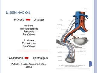 DISEMINACIÓN
Primaria Linfática
Derecho
Intercavoaórticos
Precavos
Preaórticos
Izquierda
Paraaórticos
Preaórticos
Secundaria Hematógena
Pulmón, Hígado,Cerebro, Riñón,
Ósea
 