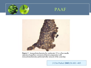 PAAF J Clin Pathol  2003 ;56:401–405 