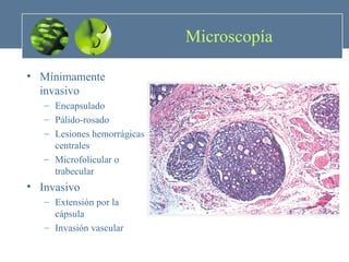 Microscopía  Mínimamente invasivo Encapsulado Pálido-rosado Lesiones hemorrágicas centrales Microfolicular o trabecular Invasivo  Extensión por la cápsula Invasión vascular 