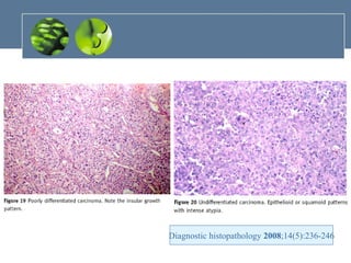 Diagnostic histopathology  2008 ;14(5):236-246 