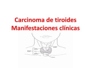 Carcinoma de tiroides
Manifestaciones clínicas
 