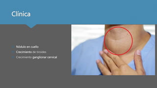 Clínica
 Nódulo en cuello
 Crecimiento de tiroides
 Crecimiento ganglionar cervical
 