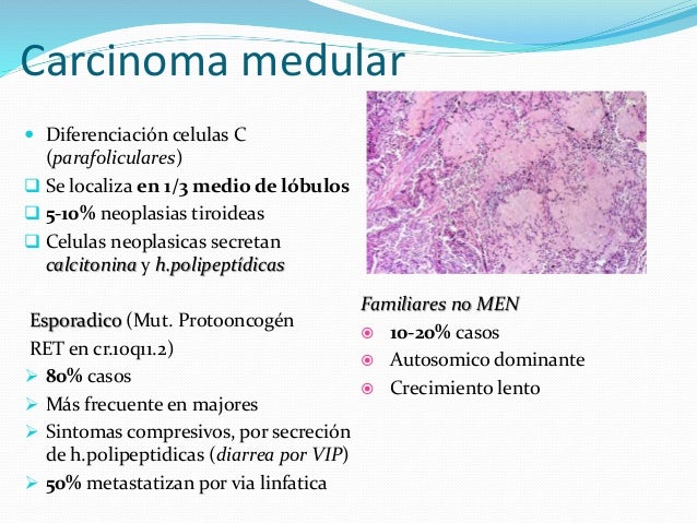 Carcinoma Medular De Tiroides Pronostico Carcinoma Medular De Tiroides Pronostico
