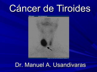 Dr. Manuel A. UsandivarasDr. Manuel A. Usandivaras
Cáncer de TiroidesCáncer de Tiroides
 