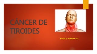 CÁNCER DE 
TIROIDES 
BURGOS HERRERA SOL 
 