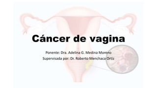 Cáncer de vagina
Ponente: Dra. Adelina G. Medina Moreno
Supervisada por: Dr. Roberto Menchaca Ortiz
 