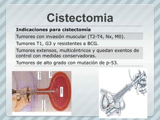 Cistectomia
Indicaciones para cistectomía
Tumores con invasión muscular (T2-T4, Nx, M0).
Tumores T1, G3 y resistentes a BCG.
Tumores extensos, multicéntricos y quedan exentos de
control con medidas conservadoras.
Tumores de alto grado con mutación de p-53.
 