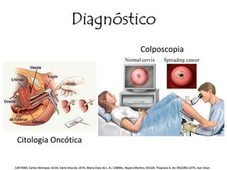 Diagnóstico 
Colposcopia 
Citologia Oncótica 
CAETANO, Carlos Henrique; SILVA, Dario Silva da; LEITE, Maria Clara de L. A.; CABRAL, Nayara Martins; SOUZA, Thaynara A. de; ROLDÃO-LEITE, Isac César. 
 