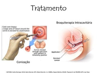 Braquiterapia Intracavitária 
Conização 
Tratamento 
CAETANO, Carlos Henrique; SILVA, Dario Silva da; LEITE, Maria Clara de L. A.; CABRAL, Nayara Martins; SOUZA, Thaynara A. de; ROLDÃO-LEITE, Isac César. 
 