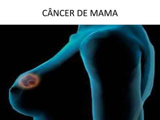 CÂNCER DE MAMA
 
