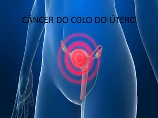 CÂNCER DO COLO DO ÚTERO
 