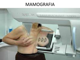 MAMOGRAFIA
 