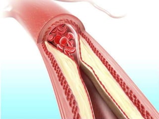 Câncer do colo do útero