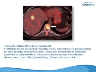 Onde as Metástases
Ósseas aparecem?
A metástase pode se desenvolver em
qualquer osso, mas com mais
frequência aparece nos ossos que
estão no centro do corpo. O local
mais comum é na coluna vertebral.
Outras áreas comuns incluem o osso
da perna (fêmur), bacia (ilíaco),
braço (úmero), costelas e crânio.
 