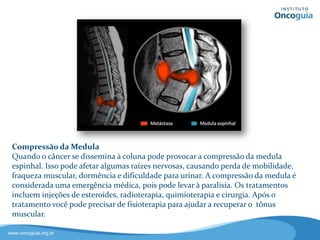 Dica Oncoguia: Após o tratamento e para ajudar a recuperar o
tônus e força muscular, o paciente pode precisar de fisioterapia.
Converse com seu médico.
Compressão da Medula
Quando o câncer se dissemina à
coluna pode provocar a compressão da
medula espinhal. Isso pode afetar
algumas raízes nervosas, causando
perda de mobilidade, fraqueza
muscular, dormência e dificuldade
para urinar. A compressão da medula
é considerada uma emergência
médica, pois pode levar à paralisia.
Os tratamentos incluem injeções de
anti-inflamatórios hormonais,
radioterapia, quimioterapia e cirurgia.
 