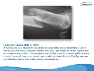 Como a Metástase afeta os
Ossos
A metástase óssea pode danificar os
ossos, tornando-os mais fracos. Com o
tempo, isso pode provocar fraturas,
mesmo durante atividades de rotina,
como tossir ou sentar em uma cadeira.
Em outras circunstâncias, a metástase
óssea pode causar o endurecimento do
osso, mas mesmo assim existe o risco
de fratura.
 