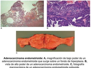 Adenocarcinoma endometrioide: A, magnificación de bajo poder de un 
adenocarcinoma endometrioide que surge sobre un fondo de hiperplasia. B, 
vista de alto poder de un adenocarcinoma endometrioide. C, fotografía 
macroscópica de un adenocarcinoma endometrioide polipoide. 
 