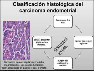 Clasificación histológica del 
carcinoma endometrial 
Representa 5 a 
10% 
tumor tipo II muy 
agresivo 
surgen del 
endometrio 
atrófico 
células presentan 
atipia nuclear 
marcada. 
Carcinoma seroso papilar uterino (alta 
magnificación). Las células tumorales 
están dispuestas en papilas y casi siempre 
son pleomórficas, con intensa actividad 
 