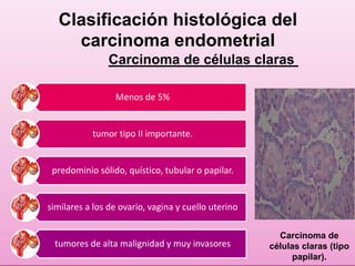 Clasificación histológica del 
carcinoma endometrial 
Carcinoma de células claras 
Menos de 5% 
tumor tipo II importante. 
predominio sólido, quístico, tubular o papilar. 
similares a los de ovario, vagina y cuello uterino 
tumores de alta malignidad y muy invasores 
Carcinoma de 
células claras (tipo 
papilar). 
 