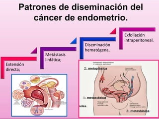 Patrones de diseminación del 
cáncer de endometrio. 
Extensión 
directa; 
Metástasis 
linfática; 
Diseminación 
hematógena, 
Exfoliación 
intraperitoneal. 
 