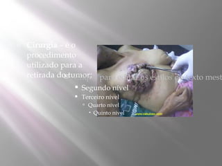    Cirurgia – é o
    procedimento
    utilizado para a
    retirada do tumor; para editar os estilos do texto mest
                Clique

                    Segundo nível
                    Terceiro nível
                      Quarto nível
                        Quinto nível
 