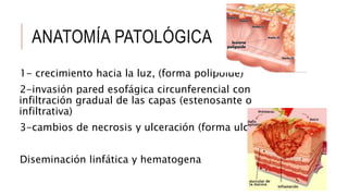 ANATOMÍA PATOLÓGICA
1- crecimiento hacia la luz, (forma polipoide)
2-invasión pared esofágica circunferencial con
infiltración gradual de las capas (estenosante o
infiltrativa)
3-cambios de necrosis y ulceración (forma ulcerada)
Diseminación linfática y hematogena
 
