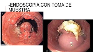 -ENDOSCOPIA CON TOMA DE
MUESTRA
 