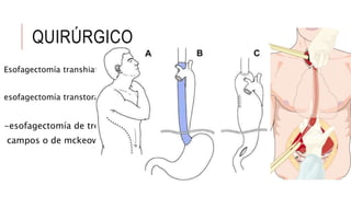 QUIRÚRGICO
Esofagectomía transhiatal
esofagectomía transtoracica
-esofagectomía de tres
campos o de mckeown
 