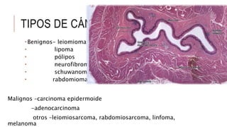 TIPOS DE CÁNCER
 Benignos- leiomioma
 lipoma
 pólipos
 neurofibroma
 schuwanoma
 rabdomioma
Malignos –carcinoma epidermoide
-adenocarcinoma
otros –leiomiosarcoma, rabdomiosarcoma, linfoma,
melanoma
 