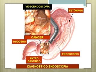 Resultados de cáncer gástrico en ChinaGastritisactiva                       MejoríaInflamación crónica                 Mejoría             Metaplasia intestinal              Sin mejoría                    Gastritis atrófica                     Sin mejoríaCáncer Gástrico