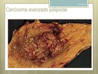CICLIPA 2006MORFOLOGIA50% - 60%  antropiloricos25% cardiasResto cuerpo y fondoCurvatura menor 40%Curvatura mayor 12%MAS FRECUENTE CURVATURA MENOR REGION ANTROPILORICA