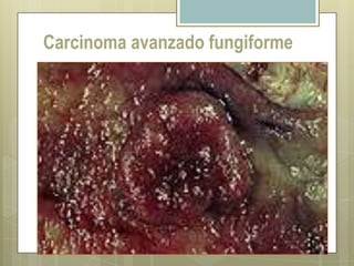 CICLIPA 2006MORFOLOGIACarcinoma gastrico precozConfinado a mucosa y submucosa independiente de la presencia o ausencia de metastasis ganglionaresCarcinoma avanzadoInfiltra  la pared muscular como minimo