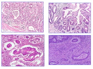 Carcinoma avanzado fungiforme 
