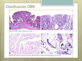 Carcinoma avanzado ulcerado