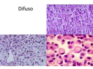 CICLIPA 2006Subtipos histologicosTipo intestinalMetaplasia intestinal en mucosa adyacenteForma estructuras glandularesCélulas con mucina intracitoplasmaticas